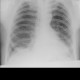 Lung fibrosis, basal: X-ray - Plain radiograph